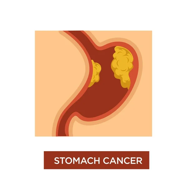 Oncología Tumor Vector Enfermedad Los Síntomas Del Cáncer Estómago — Vector de stock