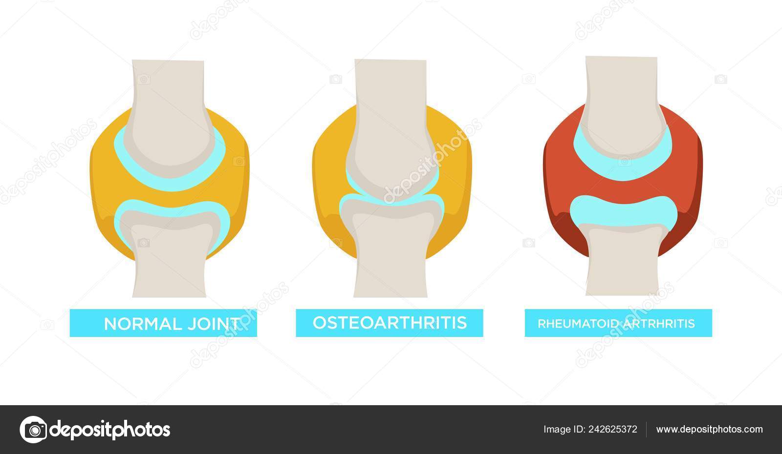 osteoarthritis csontbetegség mitől fáj a jobb vállam