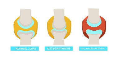 Osteoarthritis rheumatoid arthritis and normal joint vector rheumatology medicine and treatment bones disease or injury healthcare and illness human skeleton part medical problem skeletal system clipart