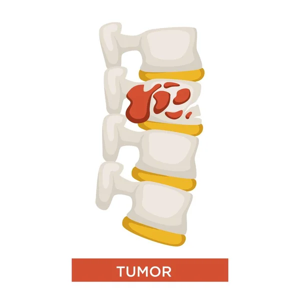 Tumeur Maladie Squelette Cancer Médecine Osseuse Inflammation Gonflement Vecteur Maux — Image vectorielle