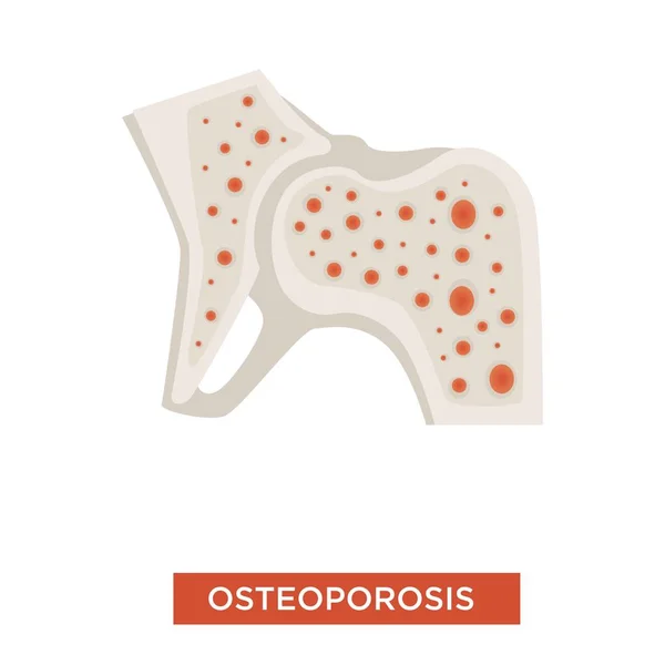 Enfermedad Del Esqueleto Osteoporosis Estructura Ósea Vector Déficit Calcio Inflamación — Vector de stock