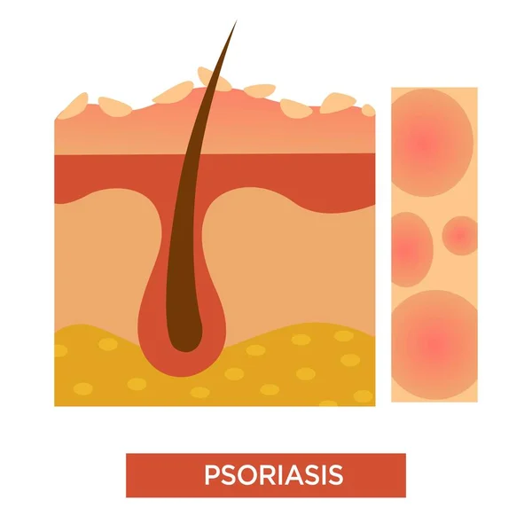 Dermatología Psoriasis Enfermedad Enfermedad Vector Estructura Piel Pelo Corporal Infección — Vector de stock