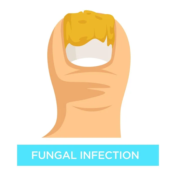 Unha Supuração Infecção Fúngica Dedo Danos Vetor Unha Remoção Doença — Vetor de Stock