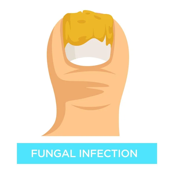 Toenail Suppuration Infección Fúngica Daño Los Dedos Del Pie Vector — Vector de stock