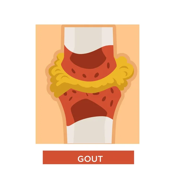 Bone Disease Gout Tissue Deposit Skeleton Anatomy Vector Illness Inflammation — Stock Vector