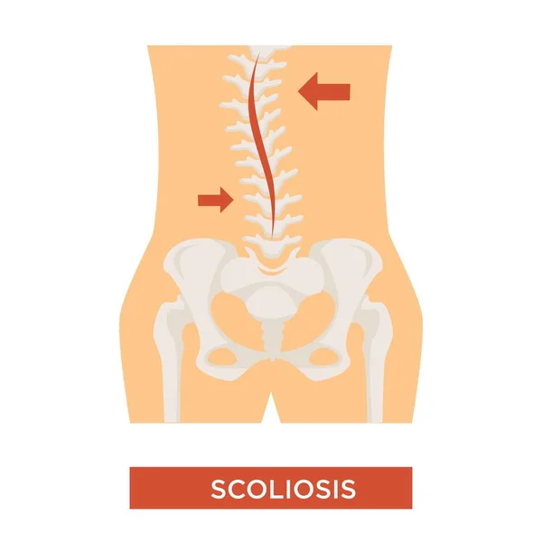 脊柱曲率脊柱侧弯疾病骨骼疾病向量人骨干结构紊乱 不适保健和医疗背痛和姿势对齐隔离身体部位 — 图库矢量图片