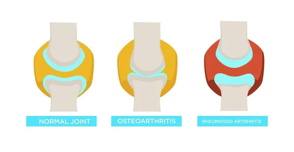 Kısım Tıbbi Sorun Iskelet Sistemi Osteoartrit Romatoid Artrit Normal Eklem — Stok Vektör