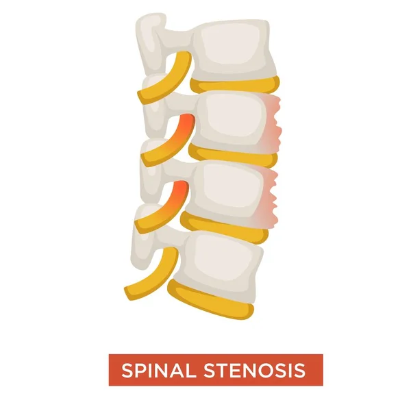 Ryggraden Sjukdomen Spinal Stenos Eller Vertebrala Sjukdom Vektor Ischias Smärta — Stock vektor