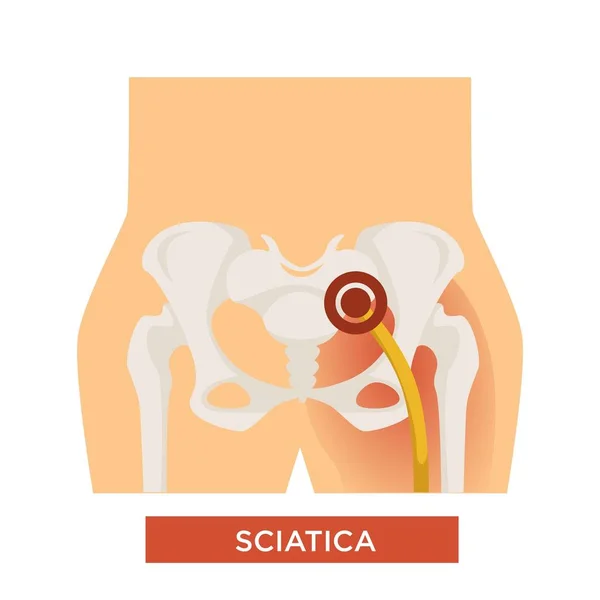 Ischialgie Rugpijn Sciatica Hip Bone Ziekte Skelet Ontsteking Vector Menselijk — Stockvector