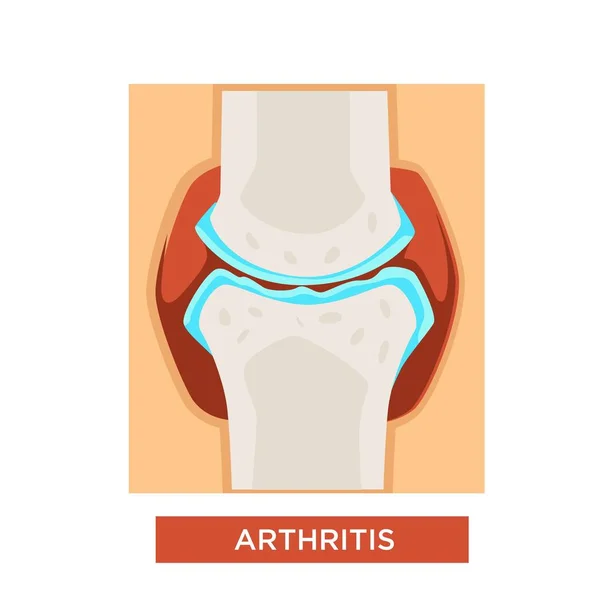 Huesos Enfermedad Articular Artritis Reumatología Vector Medicina Salud Esqueleto Enfermedad — Vector de stock