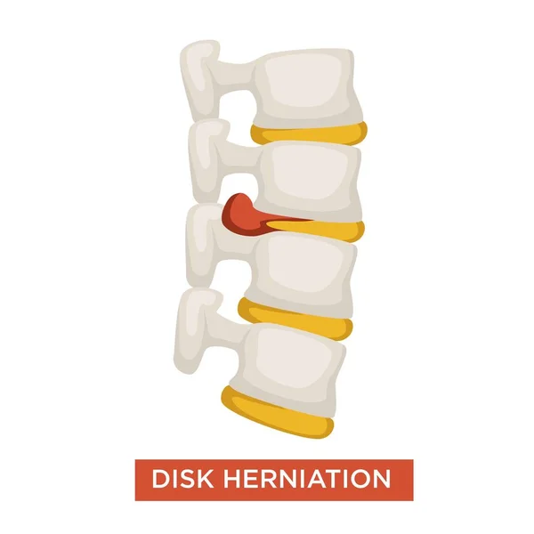 Onemocněním Páteře Herniace Disku Onemocnění Kostí Vektorové Zdravotní Problém Osteoporózy — Stockový vektor
