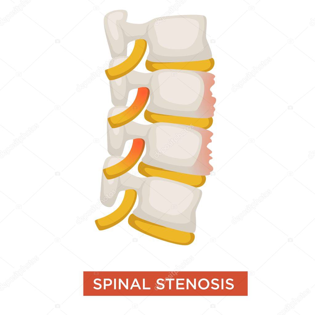 Spine disease spinal stenosis or vertebral illness vector sciatica pain human skeleton anatomy medicine and healthcare scoliosis rheumatology orthopedic problem posture or backbone isolated body part.