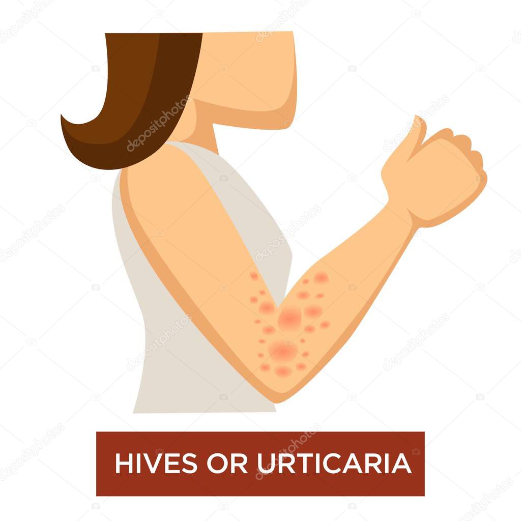 Immune disease hives or urticaria isolated female character hand with skin inflammation vector medicine or dermatology itching irritation rash dermatitis illness allergy herpes or acne on arm.