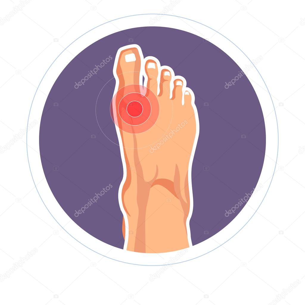 Arthritis foot joint injury toe pain or skeleton damage vector gout disease orthopedic problem arthritis and rheumatology pain or ache swelling hyperuricemia and osteoarthritis skeletal illness.