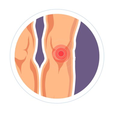 Yaralanma diz eklem ağrısı ve bacaklar tıp ve romatoloji şişlik