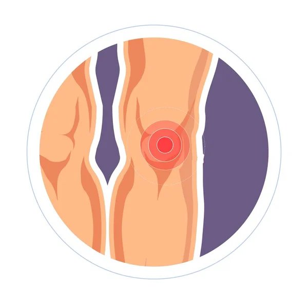 Lesión dolor en las articulaciones de la rodilla e hinchazón piernas medicina y reumatología — Vector de stock