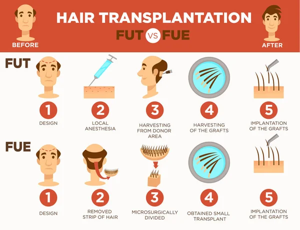 Chirurgia transplantacji włosów zabieg kosmetyczny łysy człowiek — Wektor stockowy