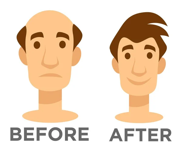 Öncesi Sonrası Etkisi Saç Ekimi Kel Adam Saç Modeli Vektör — Stok Vektör