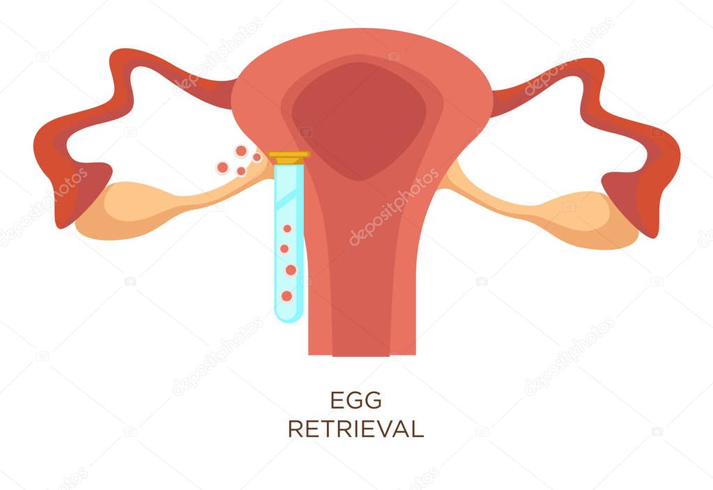 In vitro fertilization egg retrieval stage artificial insemination vector uterus and test tube with ovum female reproductive system anatomy fertility or infertility medicine reproduction clinic 