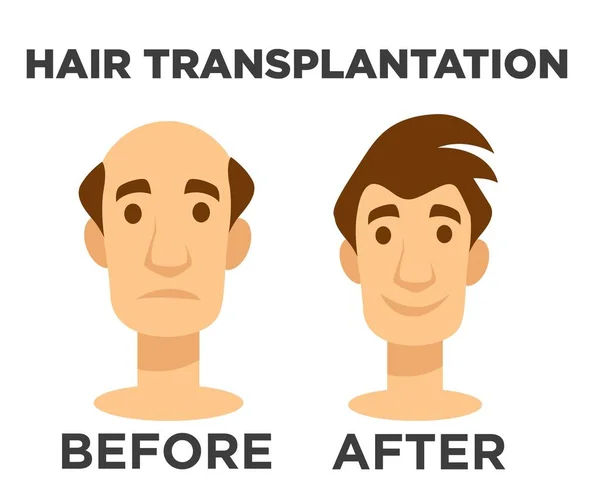 Transplantace vlasů před a po efektu plešatec — Stockový vektor