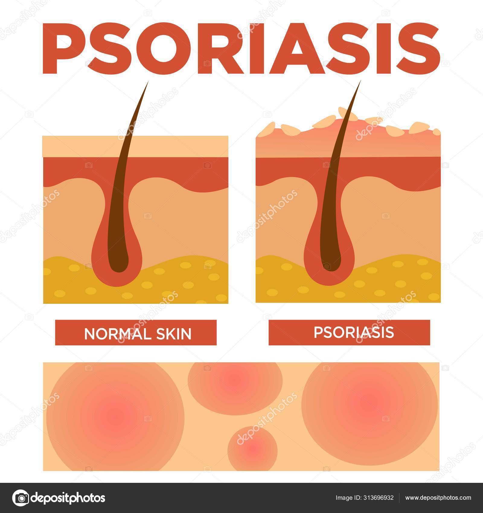 teljes psoriasis kezelsi rend lehet- e pikkelysömör aloe- val kezelni