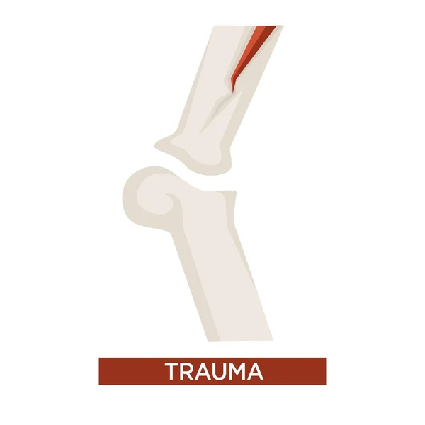 Trauma daño a la salud con fractura ósea de cerca — Vector de stock