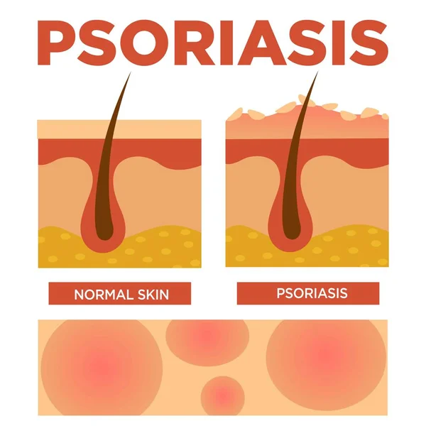Psoriasis et couches cutanées normales comparaison détaillée — Image vectorielle