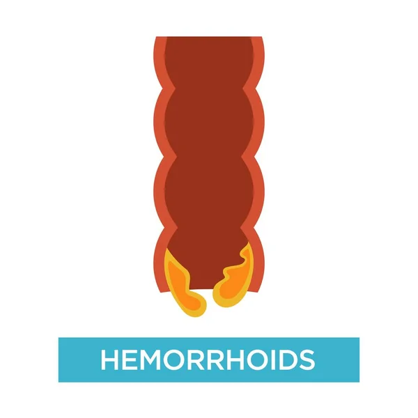 Hemorróidas externas e internas com estrutura de reto illustra —  Vetores de Stock