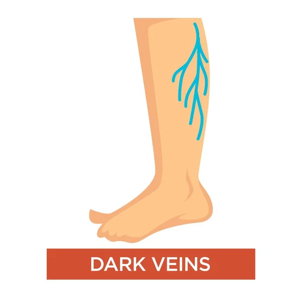 Venas varicosas oscuras en las piernas síntoma con los pies cerca — Vector de stock