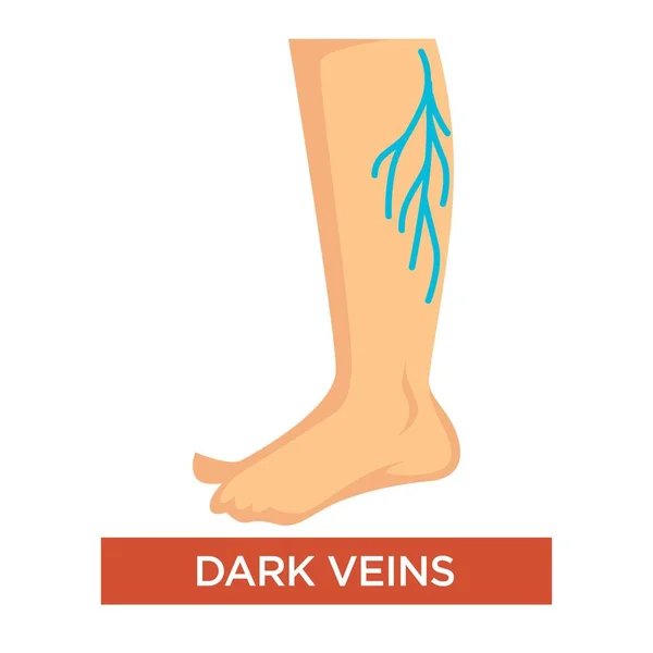 Varizes escuras nas pernas sintoma com os pés de perto — Vetor de Stock