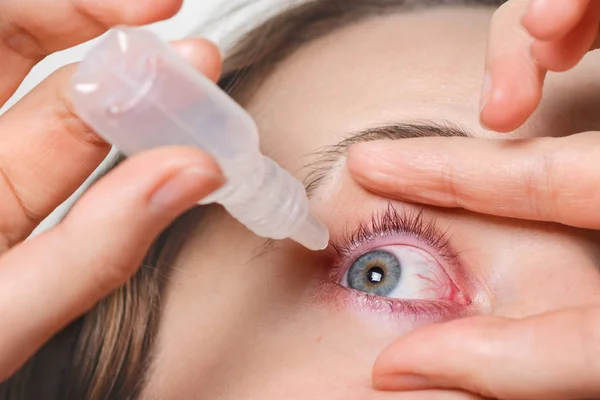 Close Shot Female Pours Drops Red Eye Tem Conjuctivite Glaucoma — Fotografia de Stock