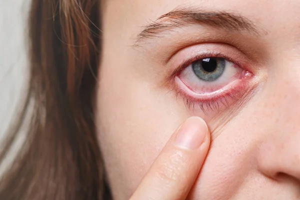 Medicina Cuidado Salud Concepto Vista Mujer Irreconocible Muestra Ojo Rojo Fotos De Stock Sin Royalties Gratis