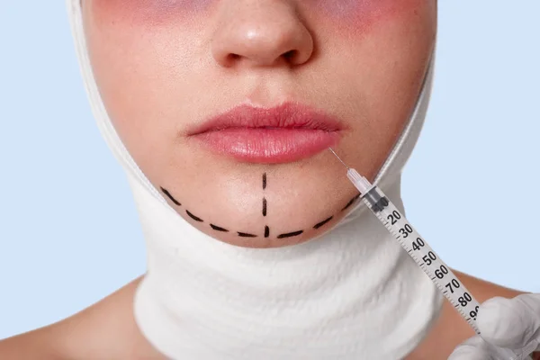 Half of face of beautiful young caucasian woman with perforation lines on chin before plastic surgery operation. Beautician holds syringe with injection, making procedures for improvement appearance.