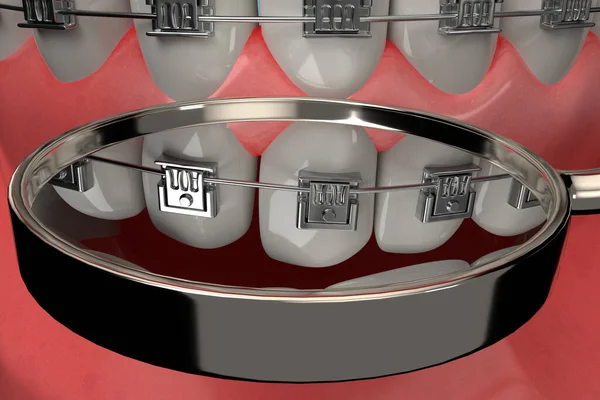 歯科用ブレースチェックからの3Dレンダリング — ストック写真