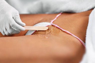 Güzellik kadın bikini üzerinde epilasyon lazer tedavisi veren