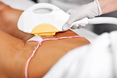 Güzellik kadın bikini üzerinde epilasyon lazer tedavisi veren