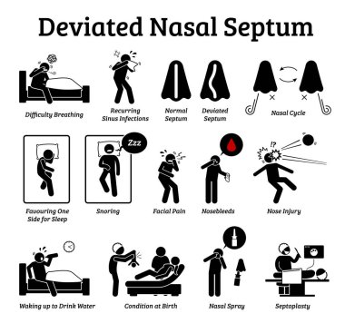 Burun dekoltesi simgeleri. Çizimler burun sorununun belirtilerini ve belirtilerini tasvir eder. Nefes darlığı, sinüs enfeksiyonu, horlama ve yüz ağrısı. Tedavisi burun spreyi ve septoplasti..
