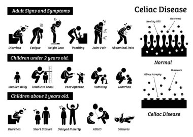 Çölyak hastalığı belirti ve bulgular. Çölyak hastalığı sorunları yetişkin ve çocuklarda illüstrasyonlar tasvir.