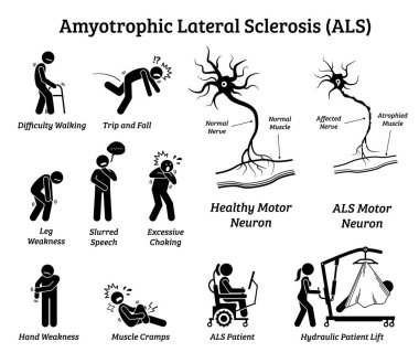 Amyotrofik lateral skleroz Als hastalığı belirti ve bulgular. Sinir sistemi ya da nörolojik hastalığı Als hastada illüstrasyonlar tasvir.