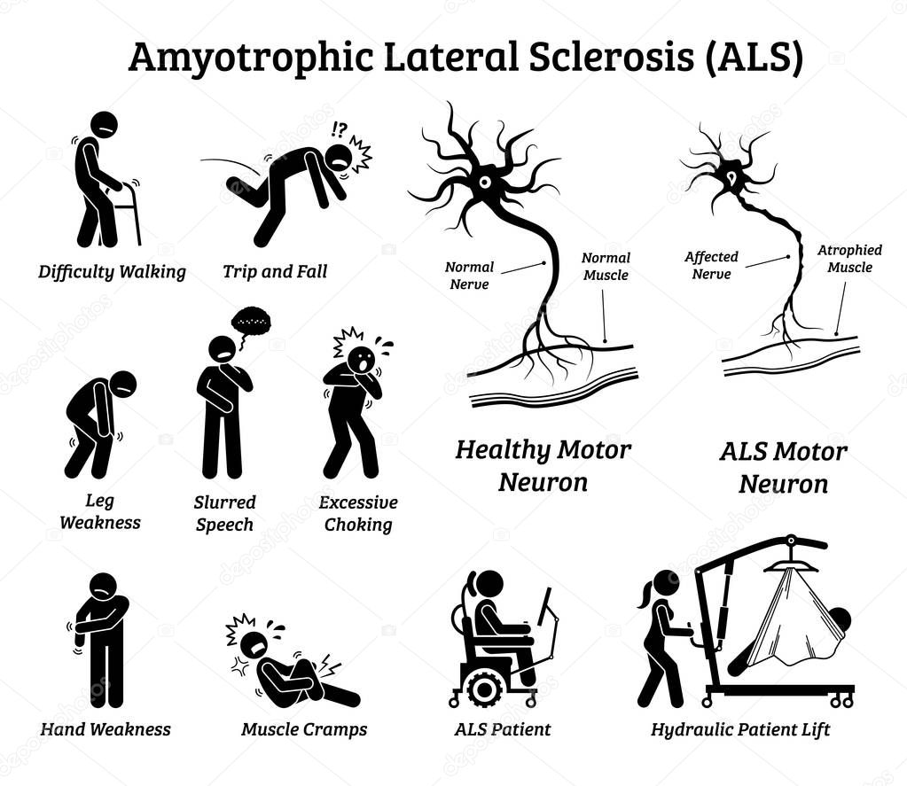 Amyotrophic lateral sclerosis ALS disease signs and symptoms. Illustrations depict nervous system or neurological disease in ALS patient.