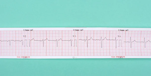 Ecg Sobre Fundo Verde — Fotografia de Stock