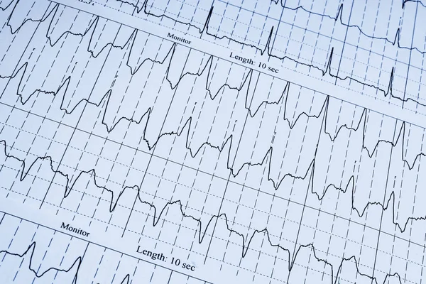 Cardiograma Com Batimento Cardíaco Segundo Plano Close — Fotografia de Stock