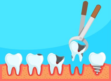 Diş tedavisi. Hastalıklı bir dişi çıkarmak ve yakın plan bir implant yerleştirmek.