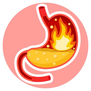 Mide ekşimesi beyaz bir adamın midesinde