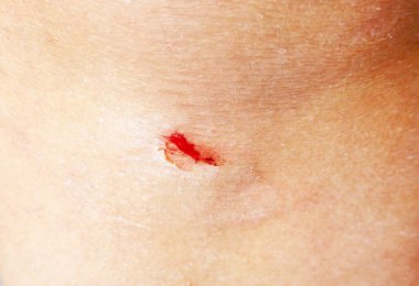 Close-up of a small wound on the knee clipart