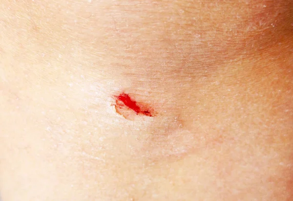 Close Small Wound Knee — Stock Photo, Image