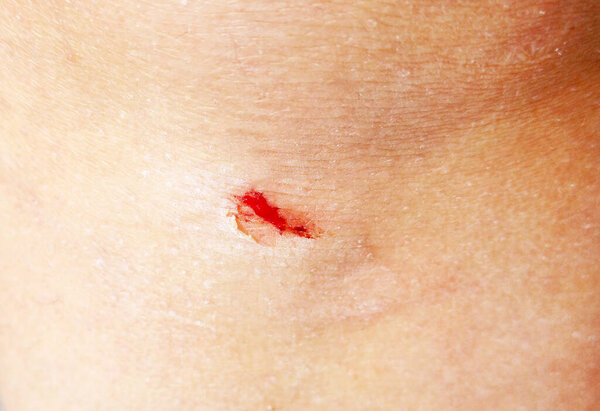 Close-up of a small wound on the knee