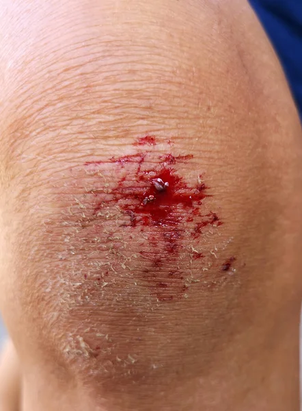 Bloody Bruise Wound Knee — Stock Photo, Image