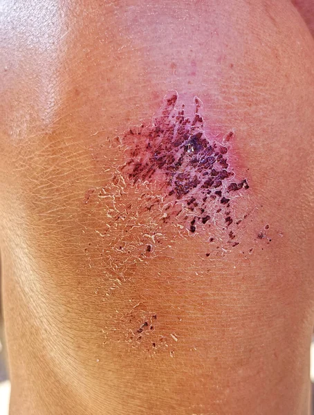 Close up on an bleeding scraped human knee