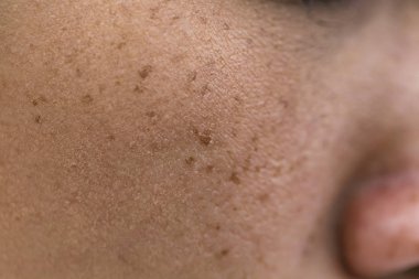 Asyalı Kadın Yüzü Yüzündeki Çiller, Cilt Sorunları